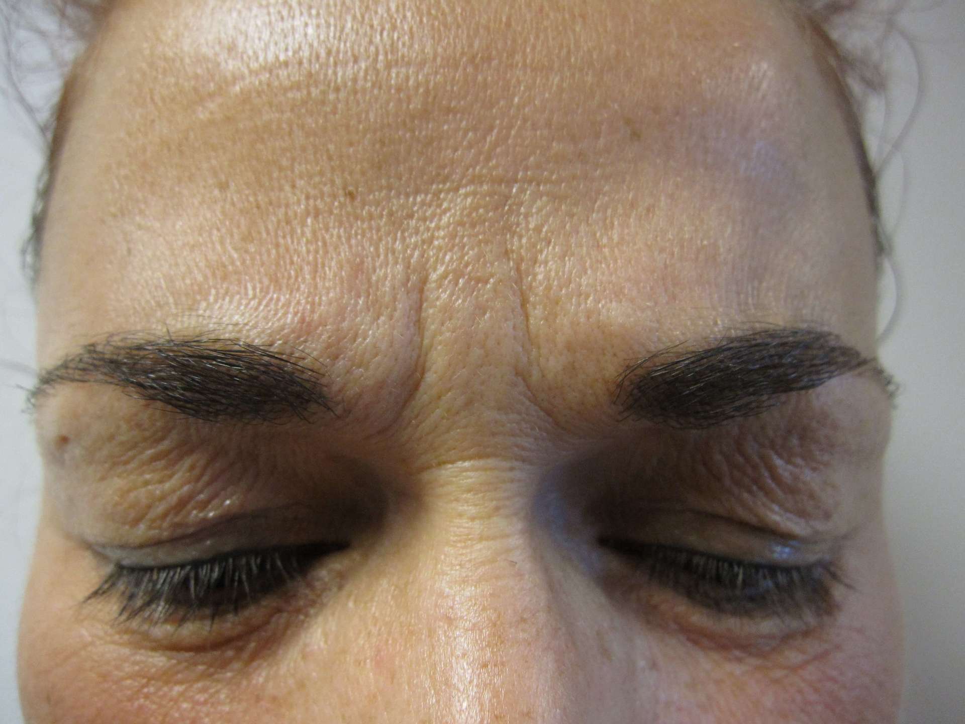 Hoe Rimpels Bovenlip Definitief te Verwijderen: Effectieve Behandelmethoden