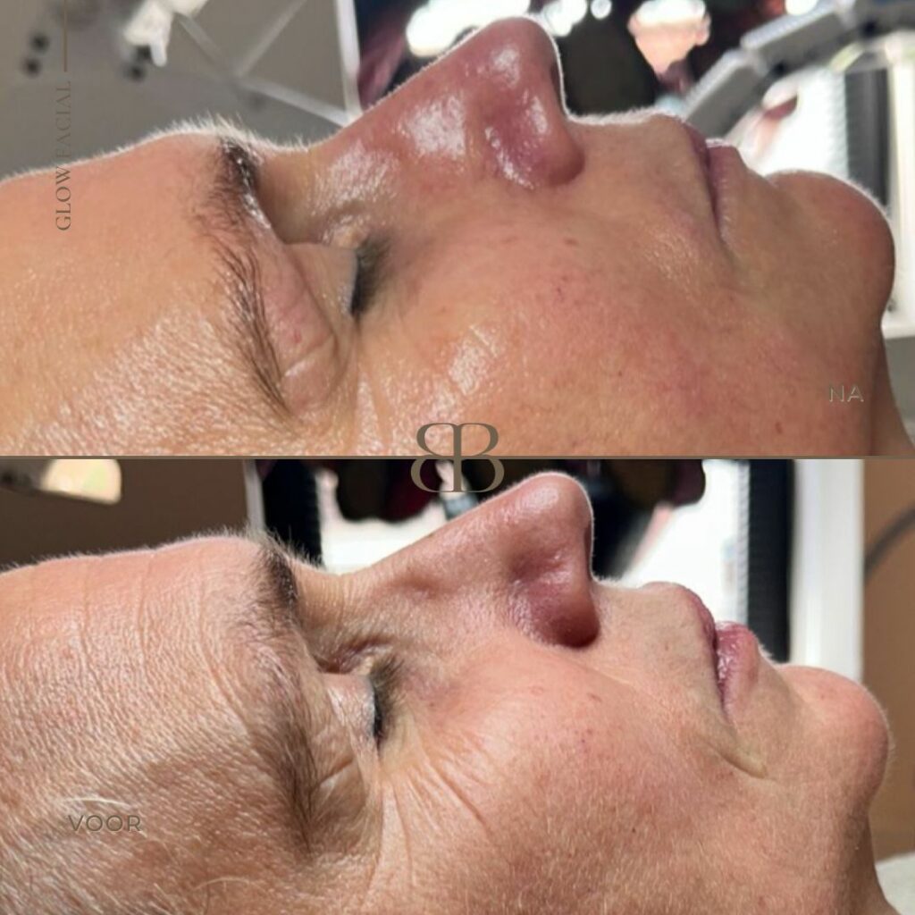 Hoe rimpels op het voorhoofd effectief verminderen