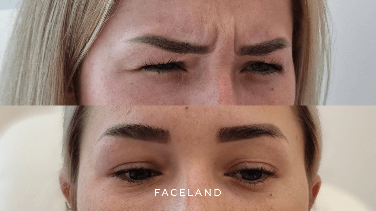 Hoe Rimpels op het Voorhoofd te Verwijderen Zonder Botox: Natuurlijke Alternatieven