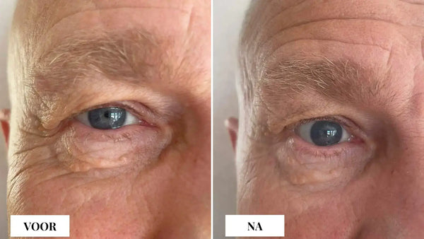 rimpels bovenlip natuurlijk verwijderen