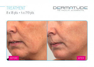 Natuurlijke manieren om rimpels te verminderen zonder botox