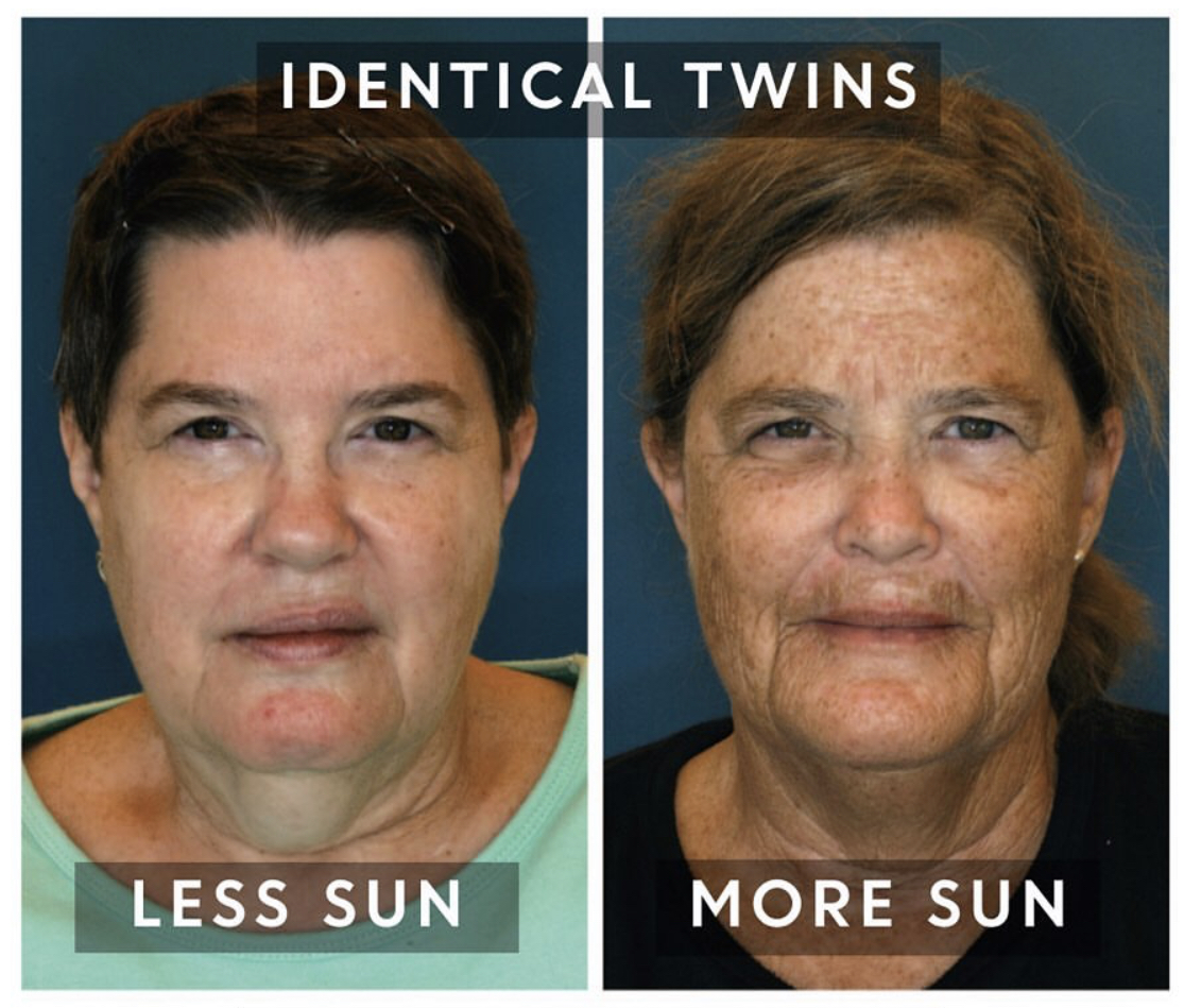 Natuurlijk Rimpels Bovenlip Verwijderen: Effectieve Tips en Trucs