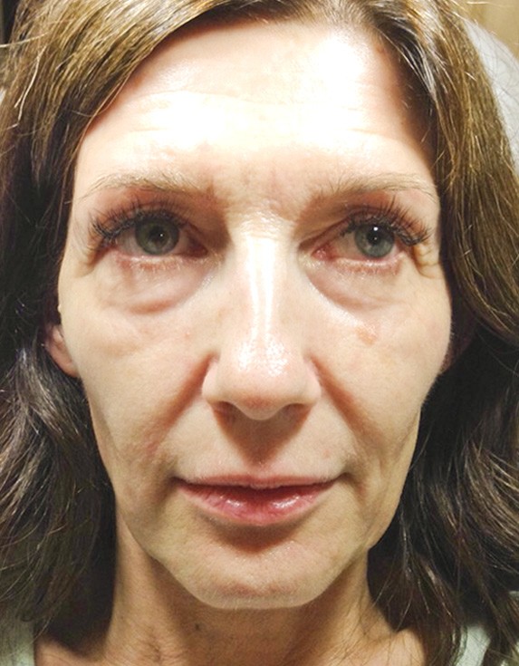 Hoe rimpels onder de ogen te verminderen zonder het gebruik van botox