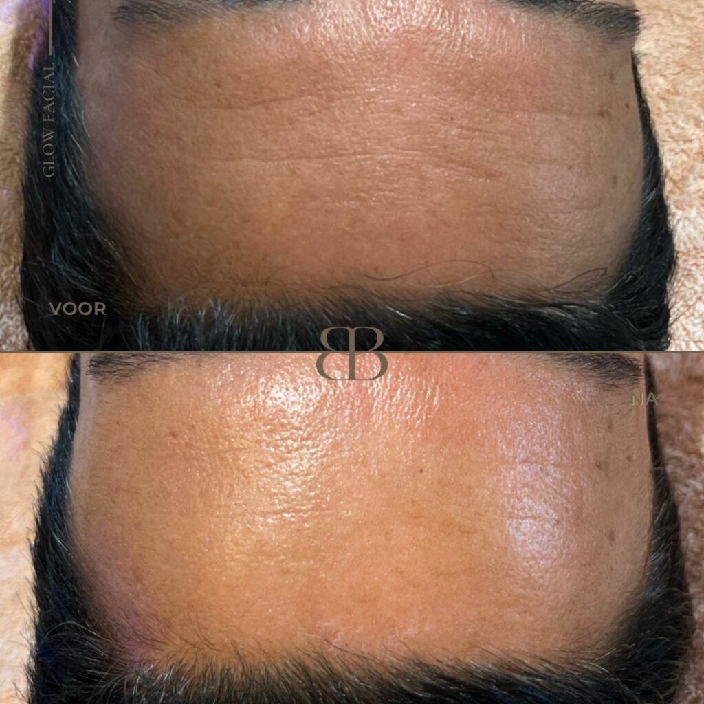 Natuurlijke manieren om rimpels te verminderen zonder botox