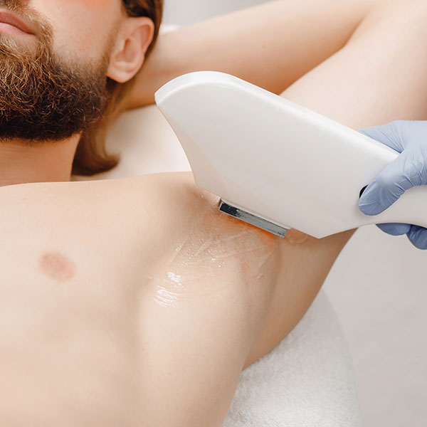 laseren lichaamshaar