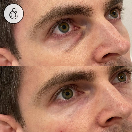 Effectieve tips om rimpels rond de ogen te verminderen