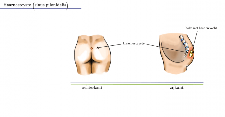 Bilnaad laseren: alles over de behandeling, voorbereiding en nazorg